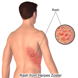 Decorative image of shingles rash